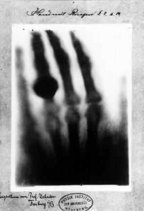 X-ray image of hand.